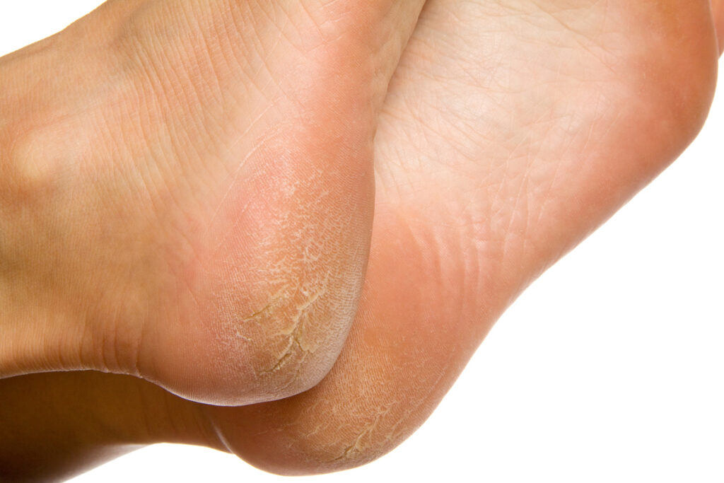 Dry and cracked soles of feet on white background